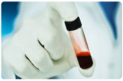 Hipertrigliceridemia test