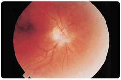 Lipemia retinal