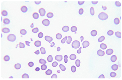 Anemia por deficiencia de vitamina B12