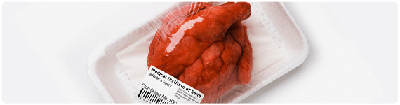 Lipoproteínas como factores de riesgo para enfermedad cardiovascular