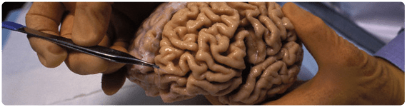 Cerebros utilzados para estudiar la enfermedad de Alzheimer