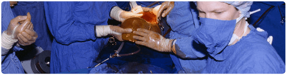 Trasplante de hígado para pacientes con NAFLD Trasplante de hígado para pacientes con NAFLD