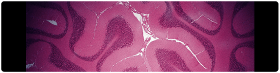 Cerebelo con lesiones características de la Enfermedad de Parkinson