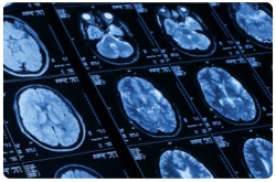 Desórdenes neurológicos