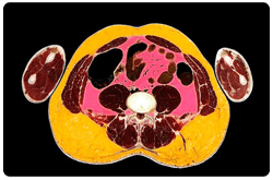 Corte abdominal, donde se observa la grasa visceral