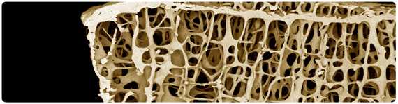 Osteoporosis en una mujer de 89 años de edad Osteoporosis en una mujer de 89 años de edad