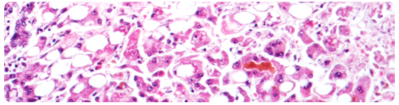 Sección del higado, donde se observan los daños causados por la Hepatitis Alcoholica Sección del higado, donde se observan los daños causados por la Hepatitis Alcoholica