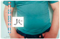 El síndrome de Prader-Willi está causado por ausencia de la contribución paterna en la región crítica Prader-Willi/Angelman en el cromosoma 15