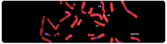 Micrografia de cromosomas con el síndrome de Prader-Willi