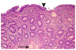 Mucosa inflamada del intestino delgado,  donde se observa la superficie aplanada (Flecha superior) y la presencia de pocas glándulas de Brunner (Flecha inferior)